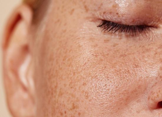 Ces marques sur votre peau sont-elles vraiment des taches pigmentaires ?