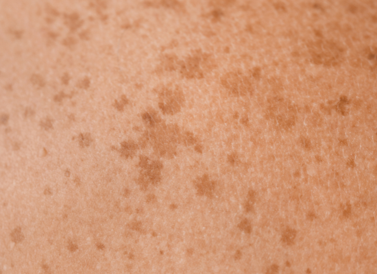Acide tranexamique topique : l'anti-taches que les dermatologues préfèrent (et ce que la science dit vraiment)